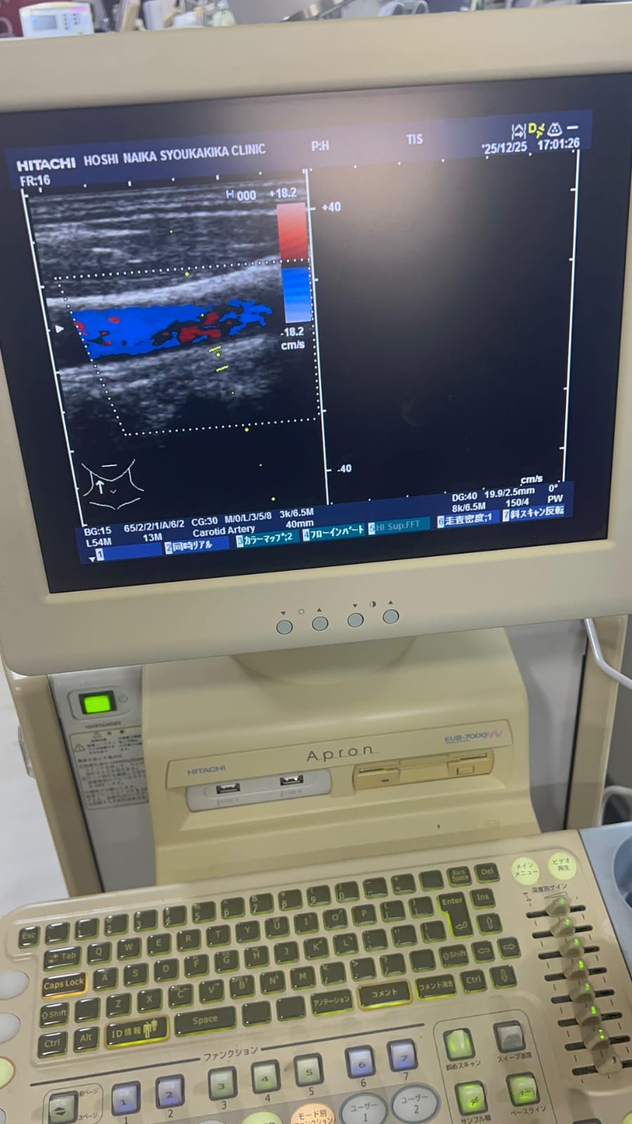 Hitachi apron ultrasound with convex and linear probe