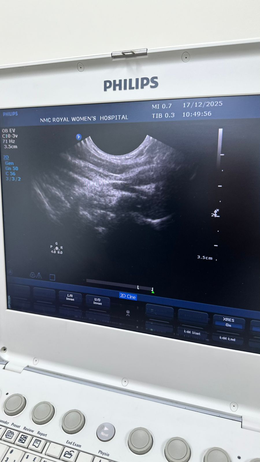 Philips CX50 portable ultrasound with convex and TVS probe