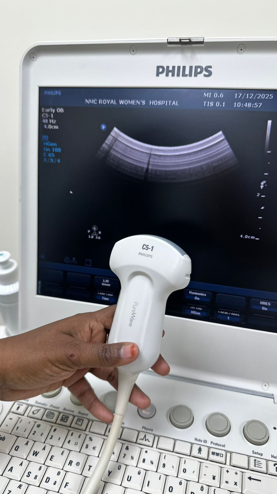 Philips CX50 portable ultrasound with convex and TVS probe