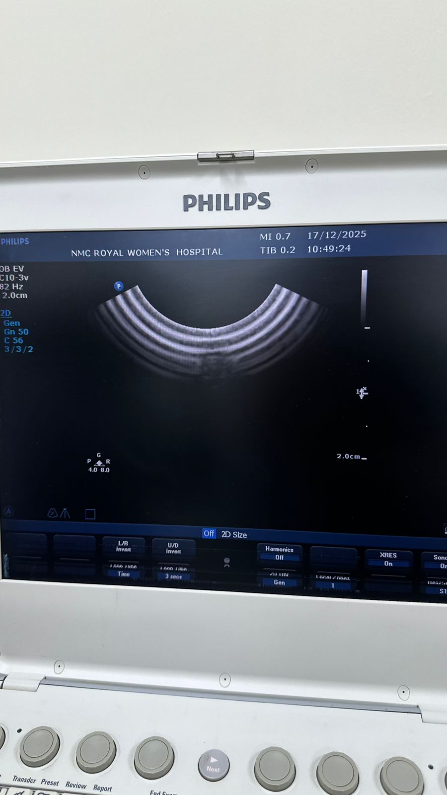 Philips CX50 portable ultrasound with convex and TVS probe